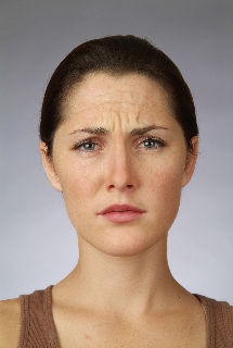 Procedimientos no quirúrgicos - Botox - Caso #2091 Before