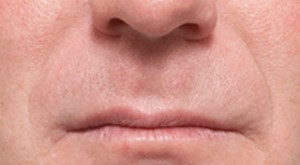 Procedimientos no quirúrgicos - Juvederm - Caso #2103 Antes
