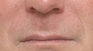 Procedimientos no quirúrgicos - Juvederm - Caso #2103 Despues