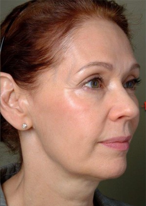 Procedimientos no quirúrgicos - Thermage - Caso #3223 Despues