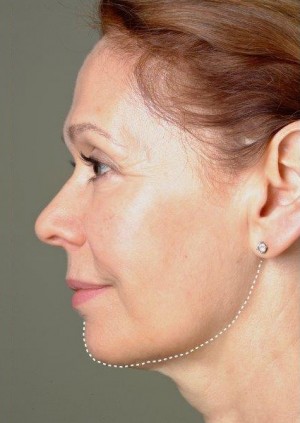 Procedimientos no quirúrgicos - Thermage - Caso #3223 Despues