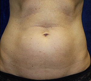 Body Procedures - Liposucción - Caso #3410 Antes