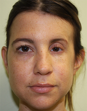 Procedimientos no quirúrgicos - Sculptra - Caso #3423 Despues