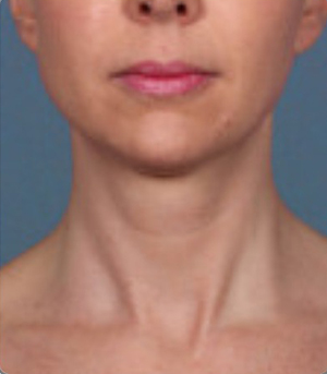 Procedimientos no quirúrgicos - Kybella - Caso #3821 Antes
