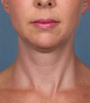Procedimientos no quirúrgicos - Kybella - Caso #3821 Despues