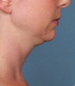 Procedimientos no quirúrgicos - Kybella - Caso #3821 Antes