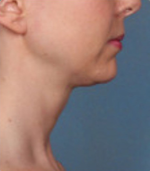 Procedimientos no quirúrgicos - Kybella - Caso #3821 Despues