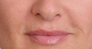 juvederm los angeles