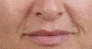 antes de Juvederm