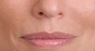 juvederm beverly hills