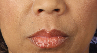 Beverly Hills Juvederm