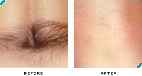 Hair Removal Los Angeles