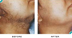Los Angeles Laser Hair Removal