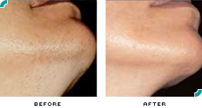 Laser Hair Removal Los Angeles