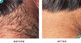 Los Angeles Hair Removal