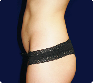 Body Procedures - Vaser Shape - Case #3410 Before