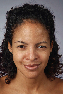 Non-Surgical Procedures - Botox - Case #2088 After