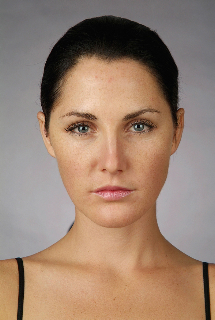 Non-Surgical Procedures - Botox - Case #2091 After