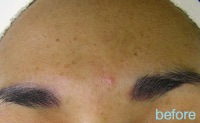 Non-Surgical Procedures - HydraFacial - Case #2151 Before