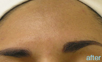Non-Surgical Procedures - HydraFacial - Case #2151 After