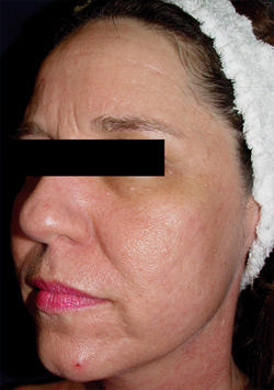 Non-Surgical Procedures - Fraxel - Case #2171 After
