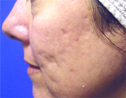 Non-Surgical Procedures - Fraxel - Case #2174 Before