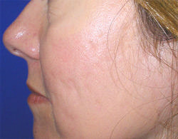 Non-Surgical Procedures - Fraxel - Case #2174 After