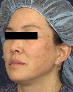 Non-Surgical Procedures - Fraxel - Case #2177 Before