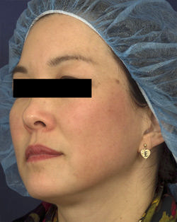 Non-Surgical Procedures - Fraxel - Case #2177 After