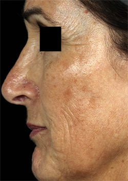 Non-Surgical Procedures - Fraxel - Case #2180 Before