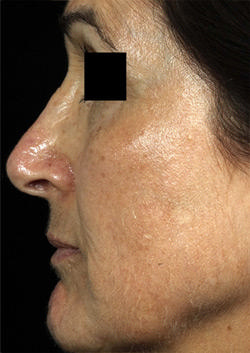 Non-Surgical Procedures - Fraxel - Case #2180 After