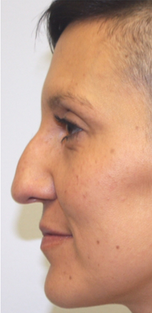 Non-Surgical Procedures - Juvederm - Case #3362 Before