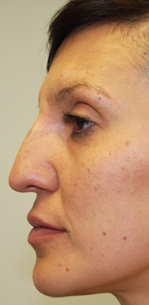 Non-Surgical Procedures - Juvederm - Case #3362 After