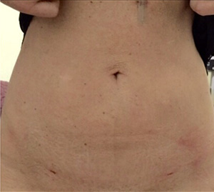 Body Procedures - Liposuction - Case #3410 After
