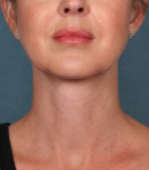 Non-Surgical Procedures - Kybella - Case #3815 After