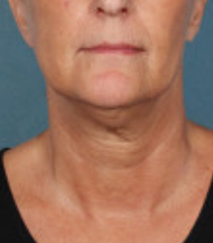 Non-Surgical Procedures - Kybella - Case #3827 Before