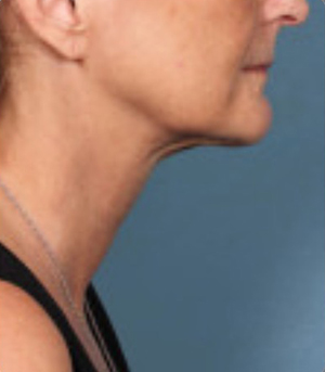 Non-Surgical Procedures - Kybella - Case #3827 After