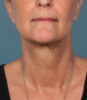 Non-Surgical Procedures - Kybella - Case #3827 After