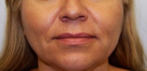 Non-Surgical Procedures - Juvederm - Case #3370 Before