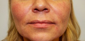 Non-Surgical Procedures - Juvederm - Case #3370 After