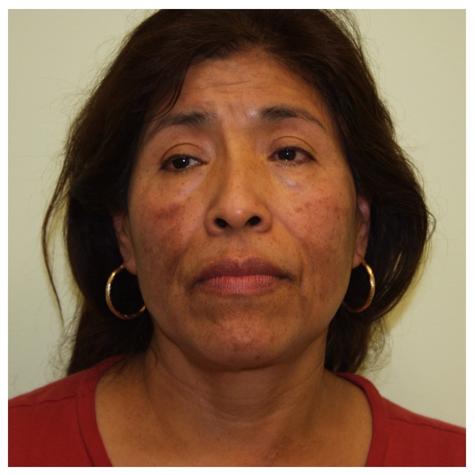 Non-Surgical Procedures - Fraxel - Case #2170 Before