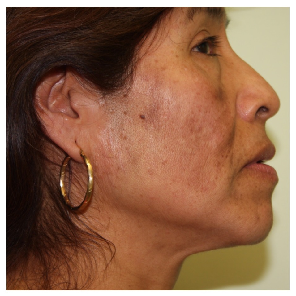 Non-Surgical Procedures - Fraxel - Case #2170 Before