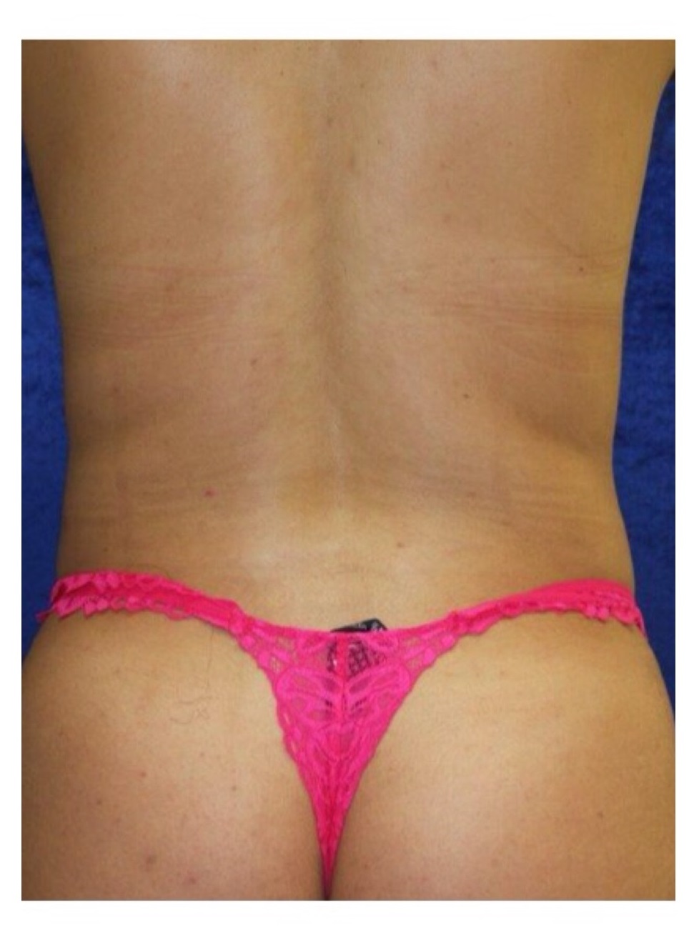 Body Procedures - Liposuction - Case #2188 After
