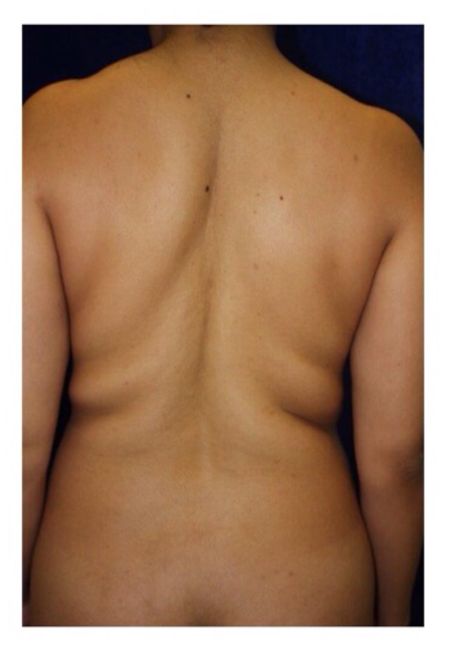 Body Procedures - Liposuction - Case #2188 Before