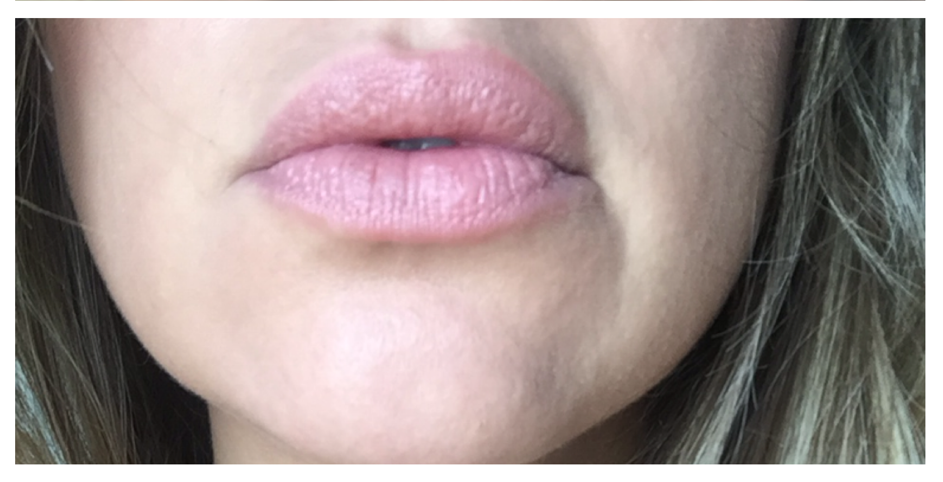 Non-Surgical Procedures - Juvederm - Case #3361 After