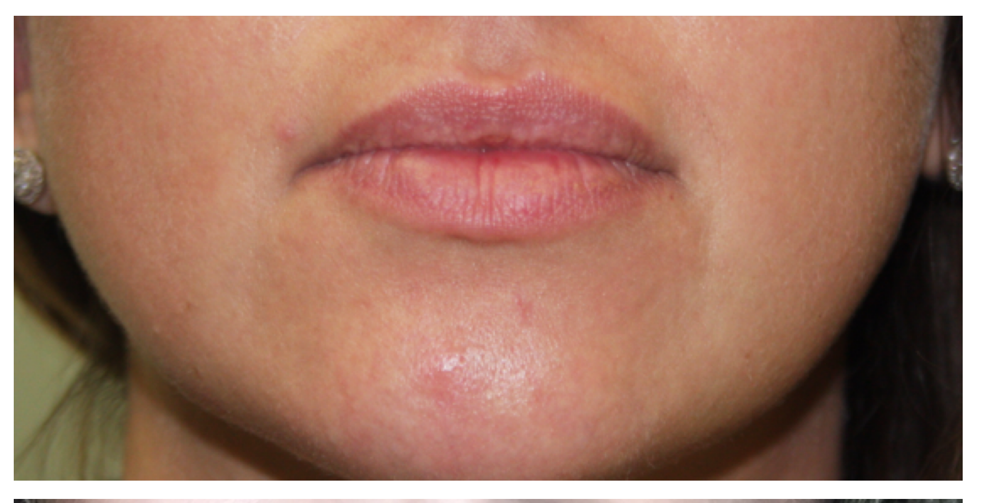 Non-Surgical Procedures - Juvederm - Case #3361 Before