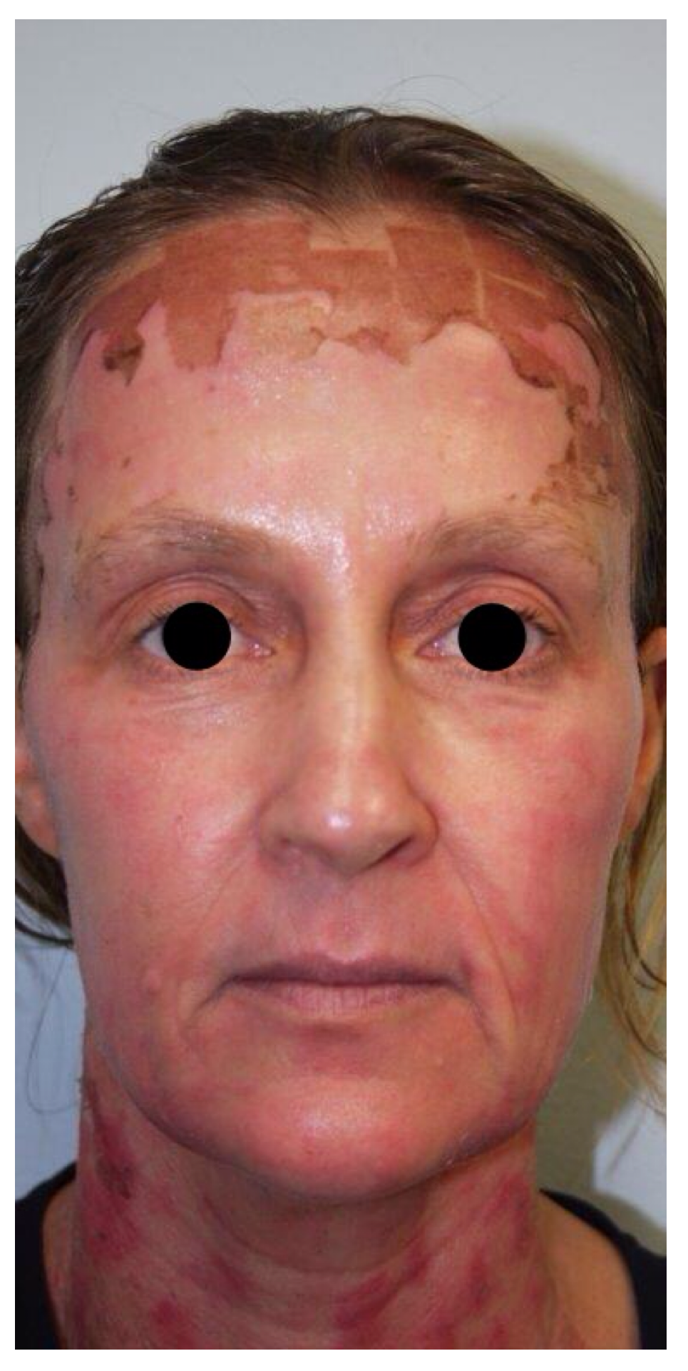 Non-Surgical Procedures - Co2 Laser resurfacing - Case #1564 Before