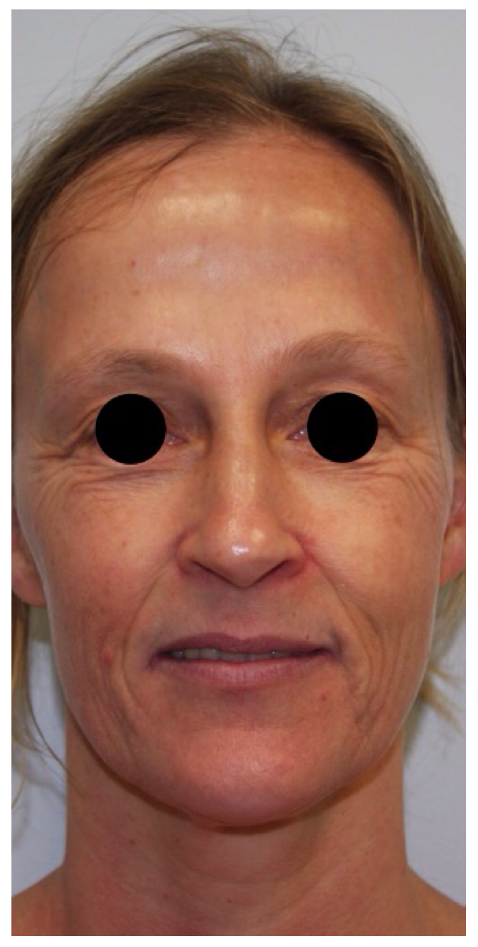 Non-Surgical Procedures - Co2 Laser resurfacing - Case #1564 After