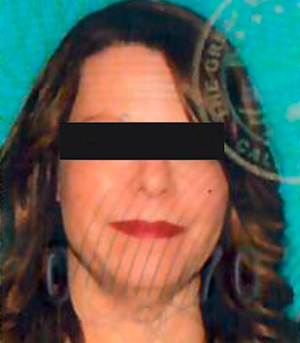 Non-Surgical Procedures - Kybella - Case #3828 Before