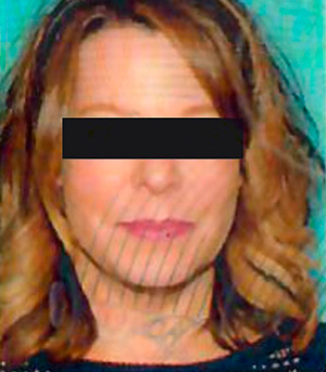 Non-Surgical Procedures - Kybella - Case #3828 After